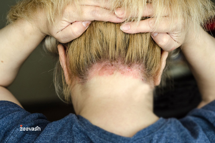 عدم توجه به بیماری‌ها و مشکلات پوستی نظیر اگزما،‌ پسوریازیس یا عفونت‌های قارچی نیز ممکن است عواقب ناخوشایندی را در پی داشته باشد.